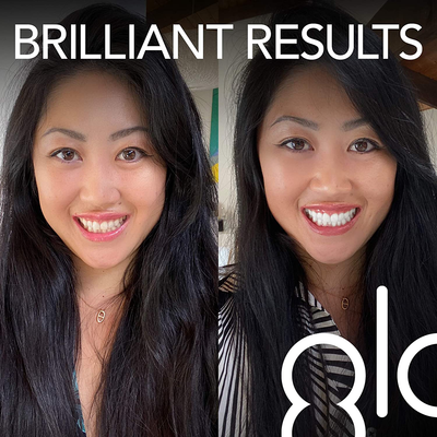 GLO Brilliant Deluxe Teeth Whitening Device Kit with Patented Blue LED Light & Heat Accelerator for Fast, Pain-Free, Long Lasting Results